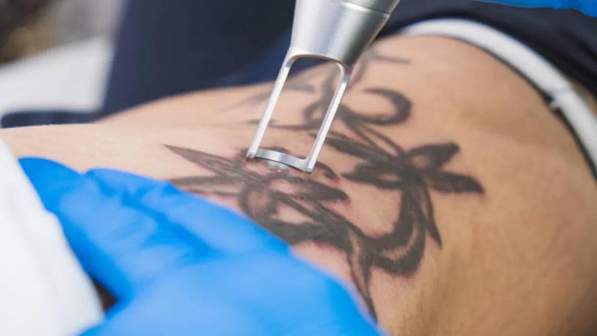 Tattoo Removal  Laserase Newcastle